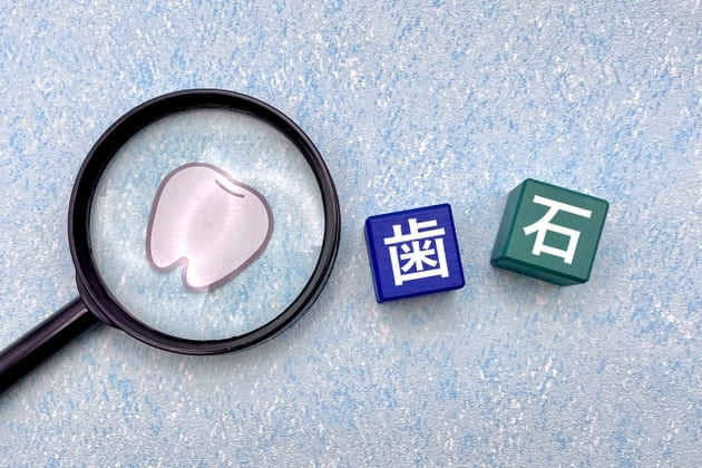 歯石